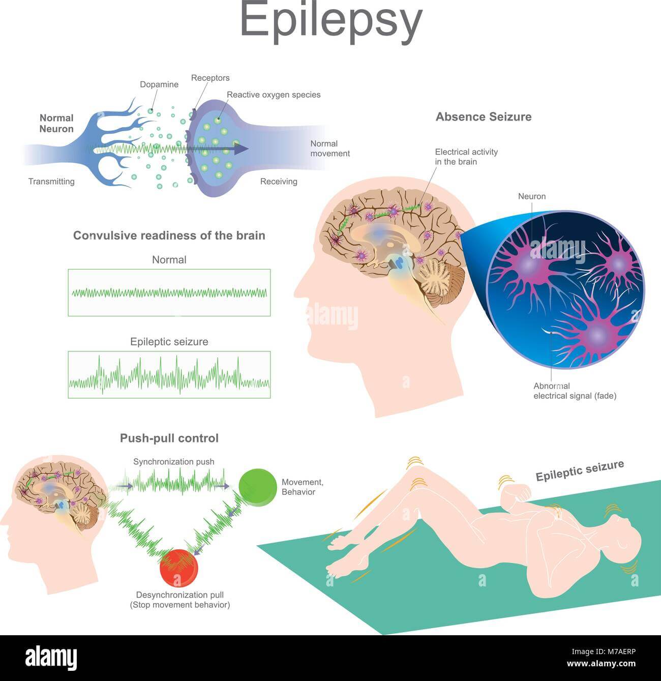 Epilepsy